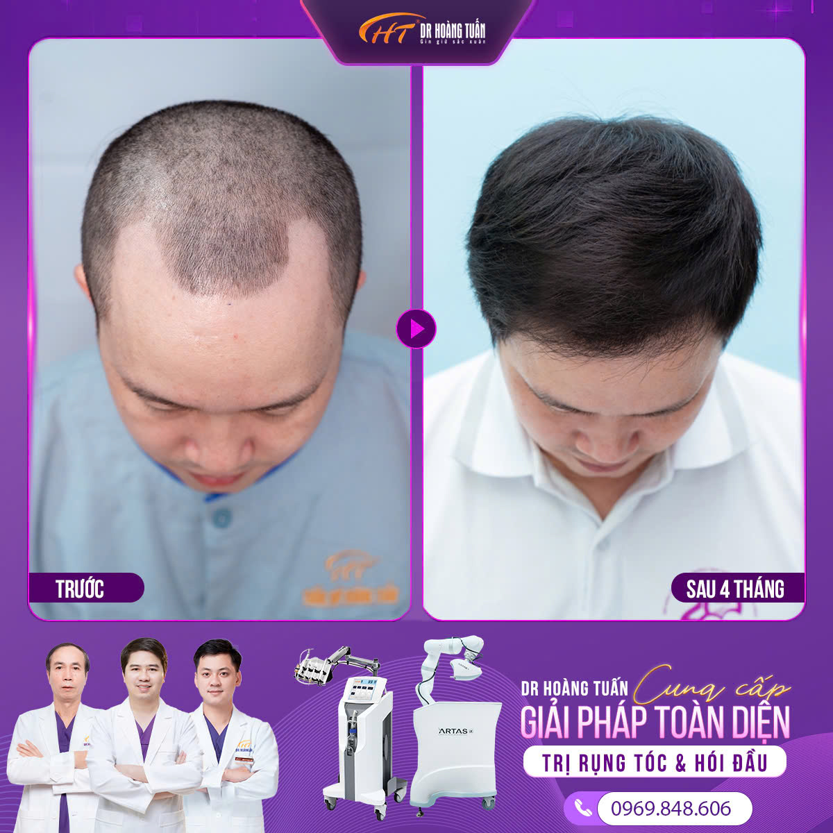Cấy tóc trị hói có hiệu quả không